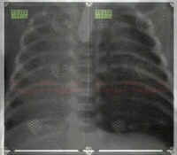 Pneumothorax | Rntgenfoto: A.D.A.M.